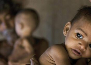 पांच साल से कम उम्र के 67 फीसदी बच्चे एनीमिया के शिकार