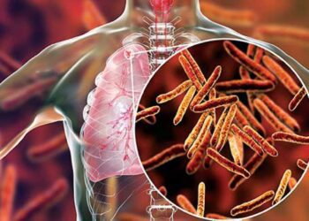 टीबी उन्मूलन के लिए मिशन मोड में सरकार