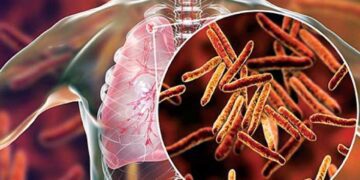 टीबी उन्मूलन के लिए मिशन मोड में सरकार