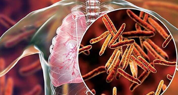 टीबी उन्मूलन के लिए मिशन मोड में सरकार