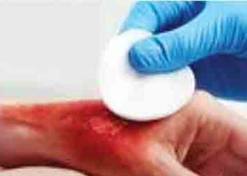 Skin grafting will become a boon, death rate will decrease in cases of burn