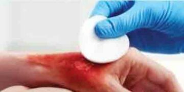 Skin grafting will become a boon, death rate will decrease in cases of burn