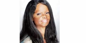Acid victims will be heard