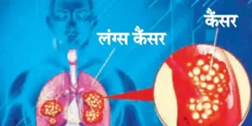 30 percent of lung cancer patients in the capital are 'non-smokers'